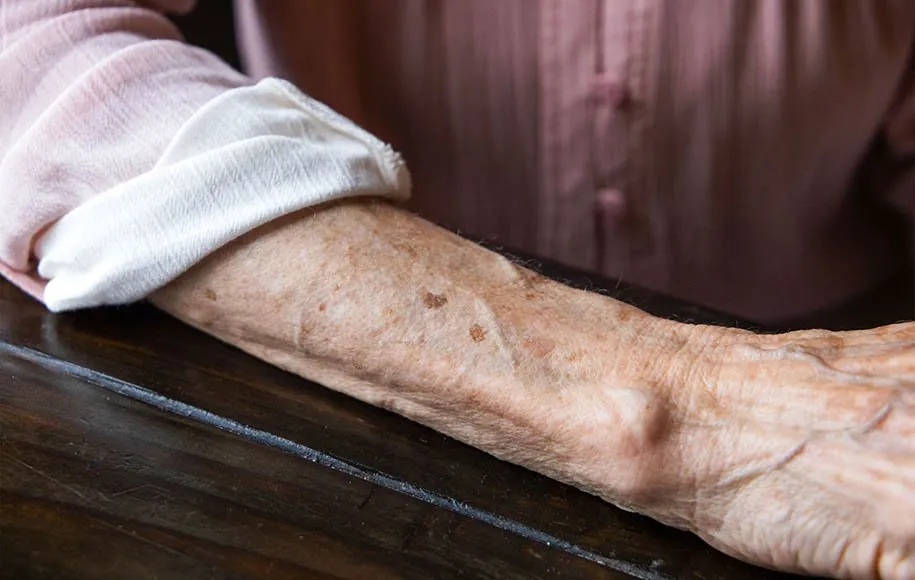 لکههای پوستی ناشی از افزایش سن