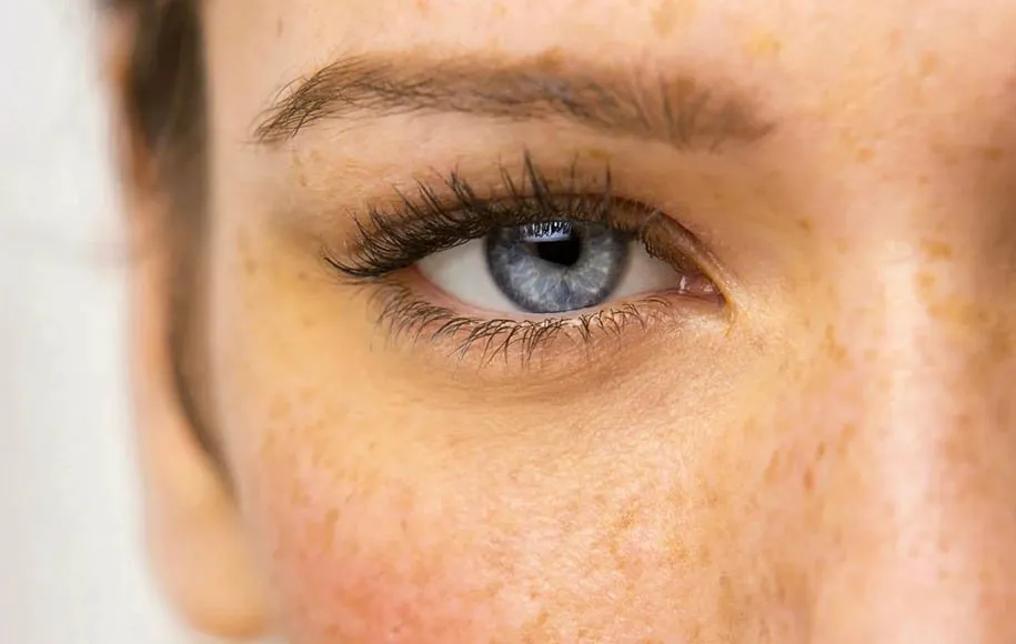راهکارهای موثر برای لکههای پوستی ناشی از افزایش سن