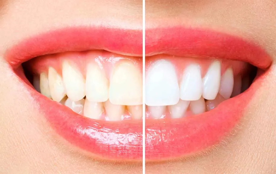 داشتن دندان‌های زرد