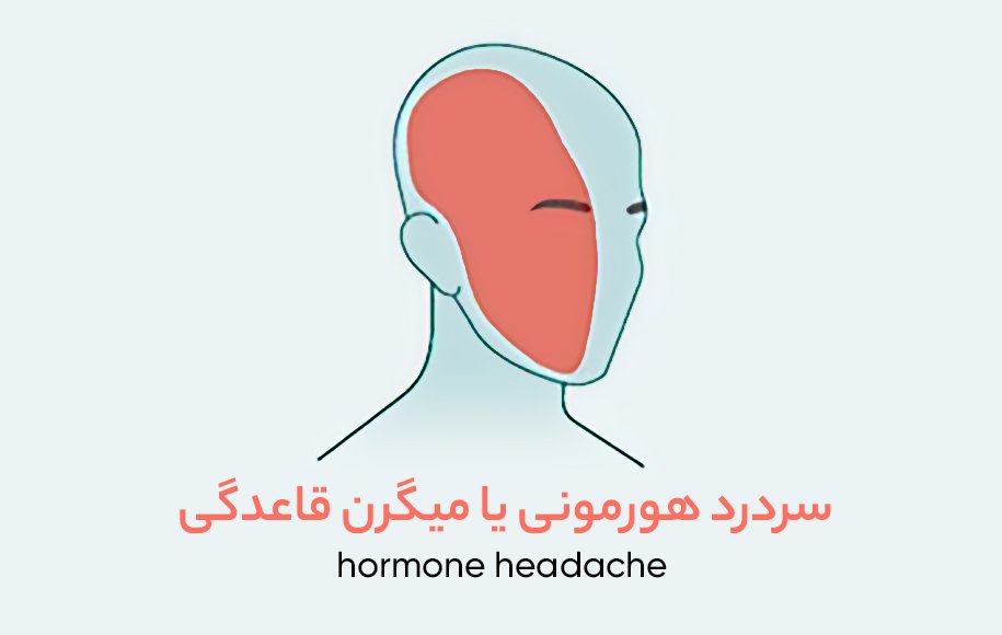 محل های سردرد هورمونی