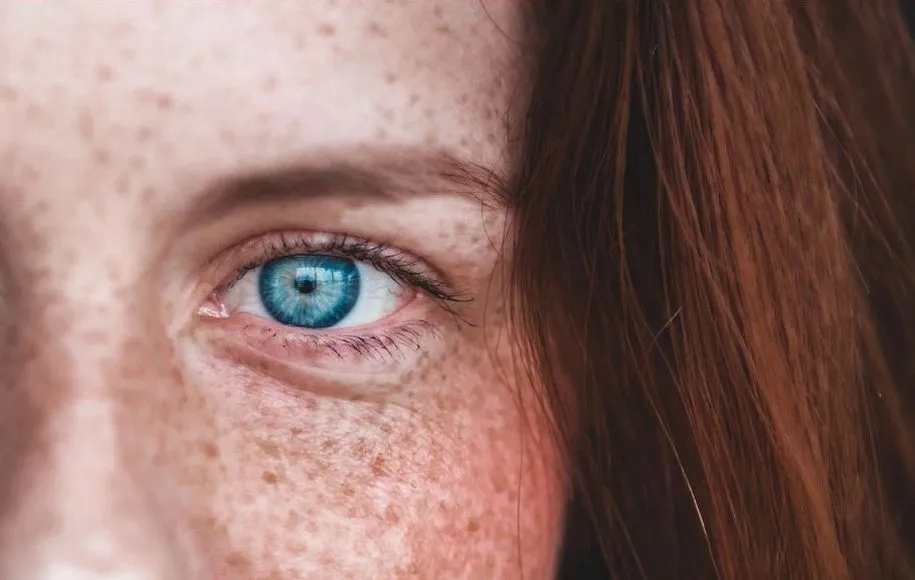 درمان کک و مک از پوست ناسالم جلوگیری میکند