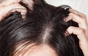 شامپو کتوکونازول چیست؛ مزایا، عوارض و نحوهی استفاده