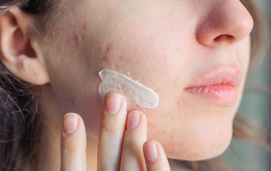 درمان جوش صورت در پوست خشک