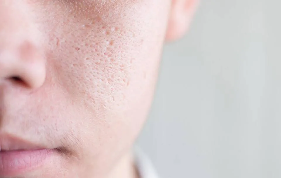 بهترین شوینده برای پوست چرب با منافذ باز