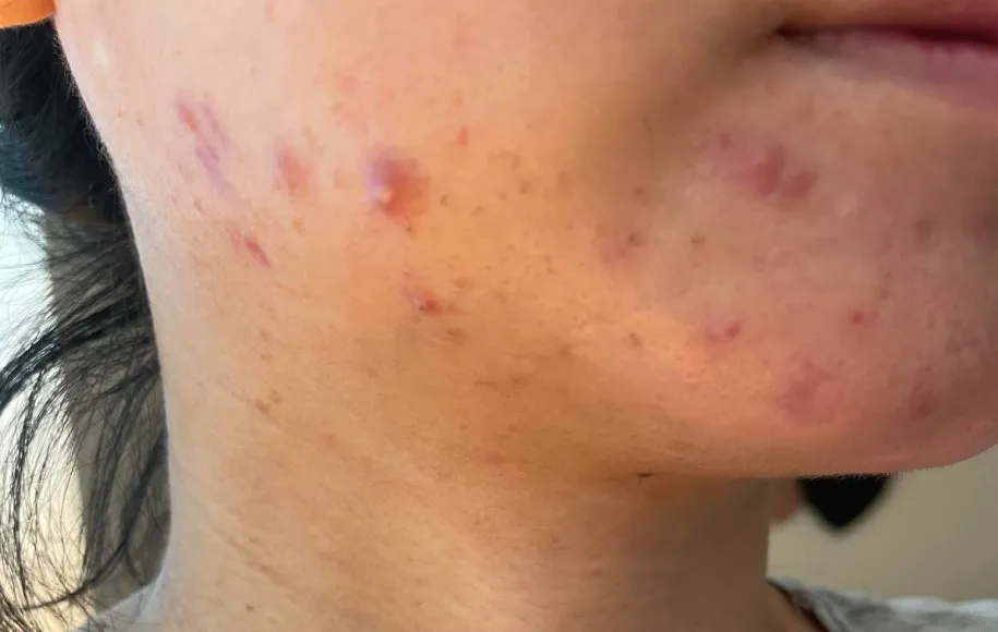 جلوگیری از بروز جوش خط فک