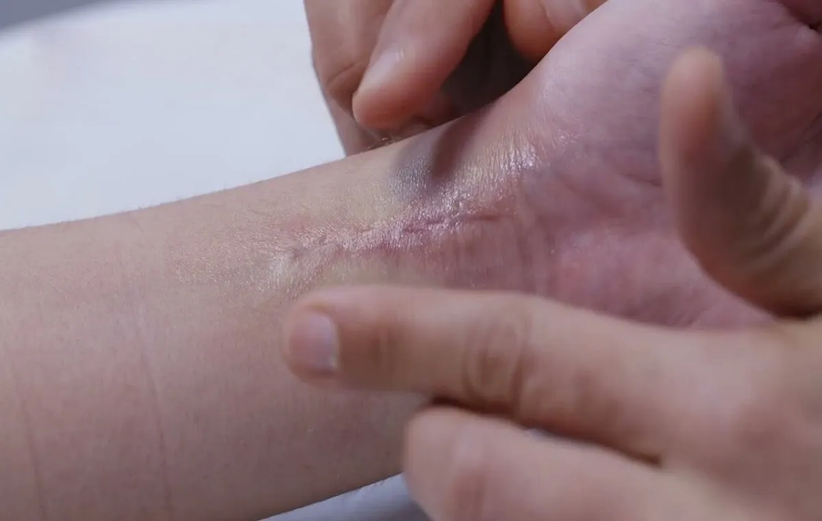 جای بخیه روی دست