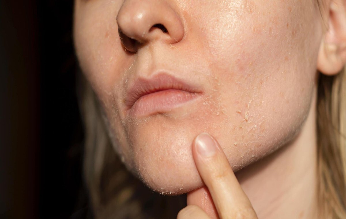 عوارض استفاده از بنزوئیل پراکسید برای پوست صورت