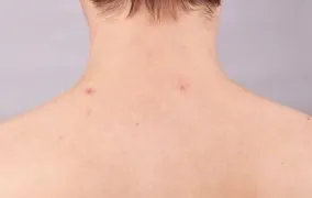 فردی که روی پشت و گردن او چند جوش دیده می‌شود