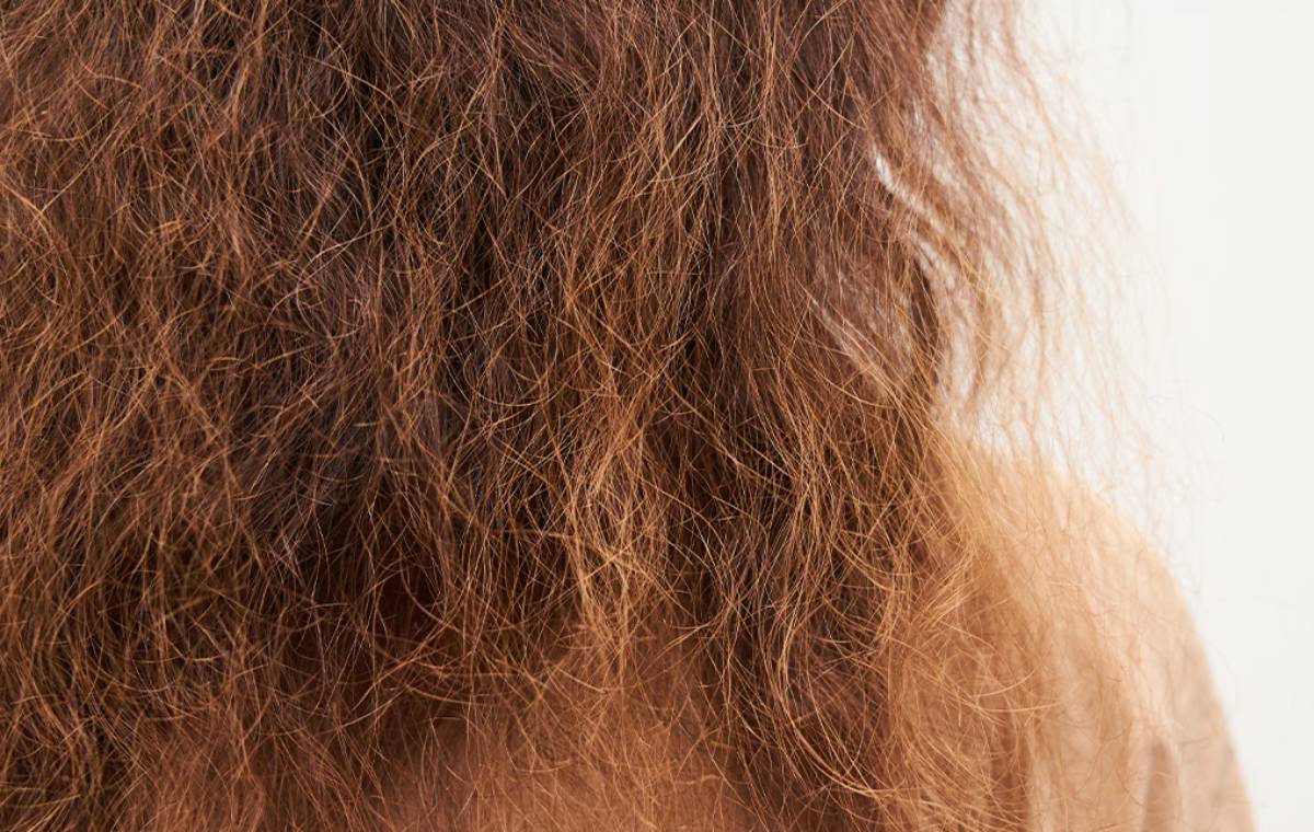درمان موی وز و سوخته 
