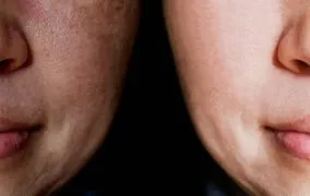 مقایسه پوستی که لکه‌های قهوه‌ای دارد و پوستی که لکه‌های قهوه‌ای ندارد