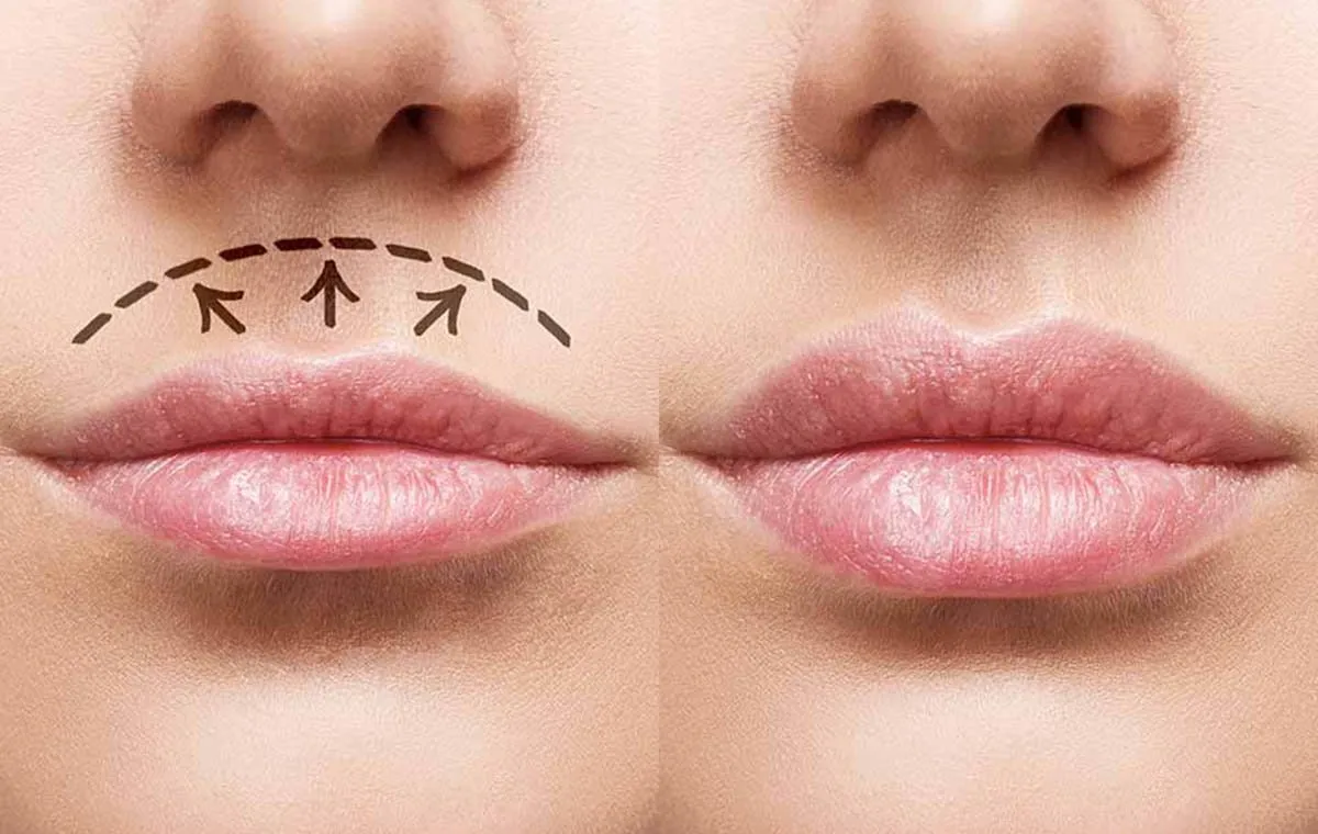 عمل لیفت لب چیست