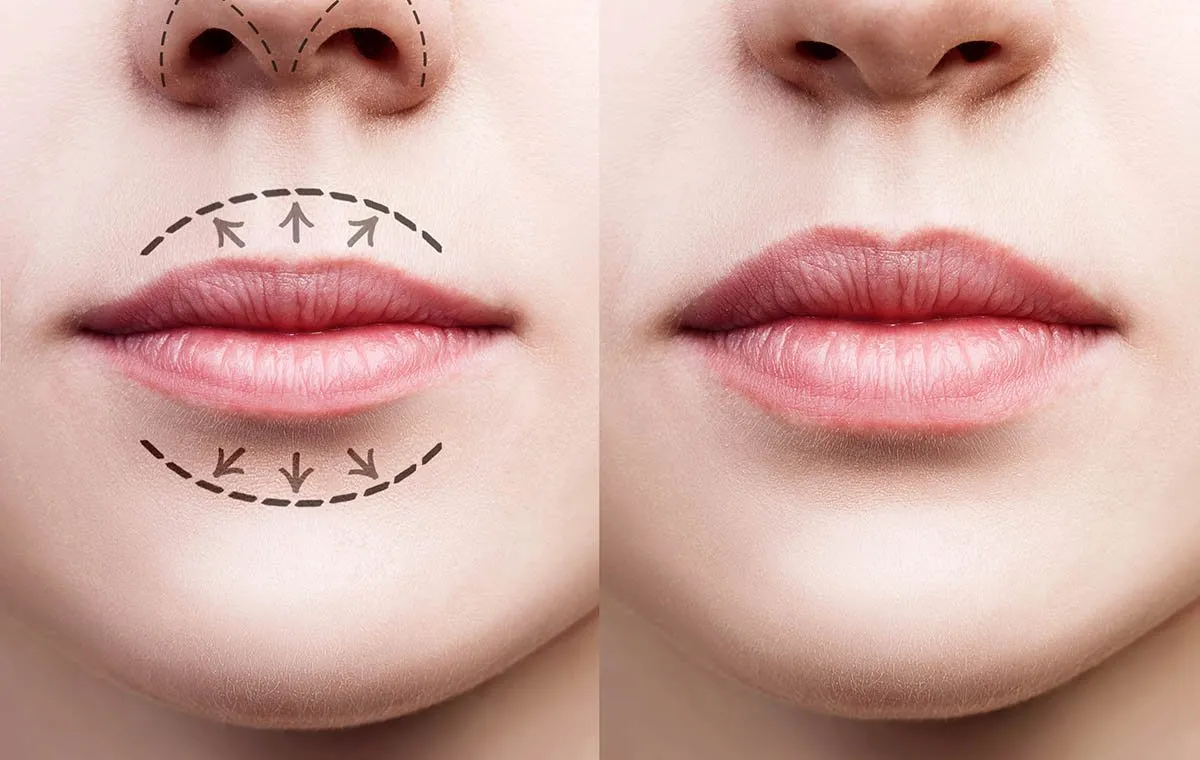 انواع جراحی لیفت لب