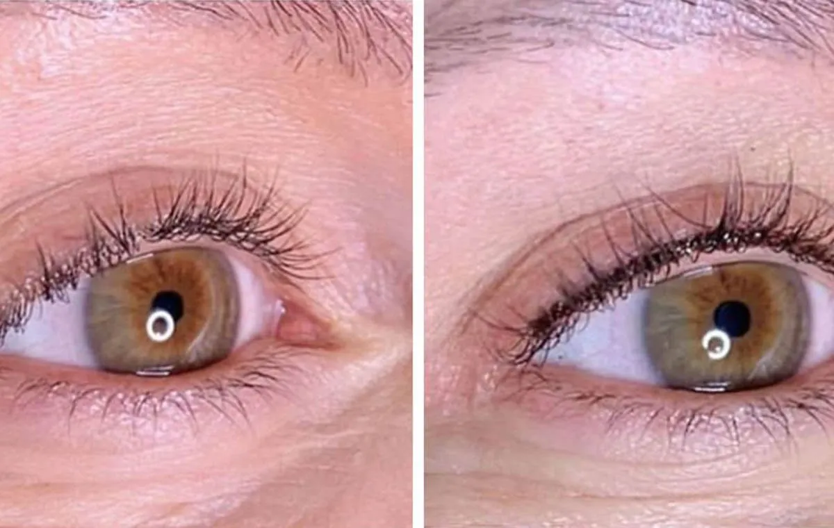 عکس بن مژه قبل و بعد