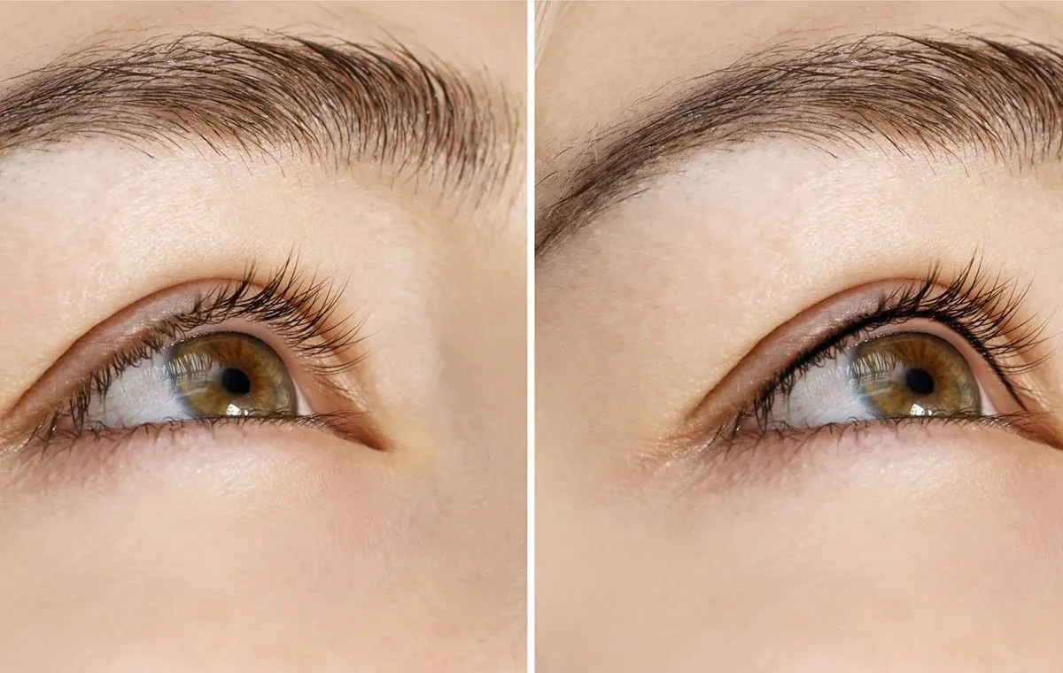 عکس بن مژه قبل و بعد