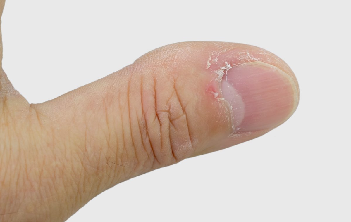 زگیل پوستی دست و اطراف ناخن و راه های درمان آن