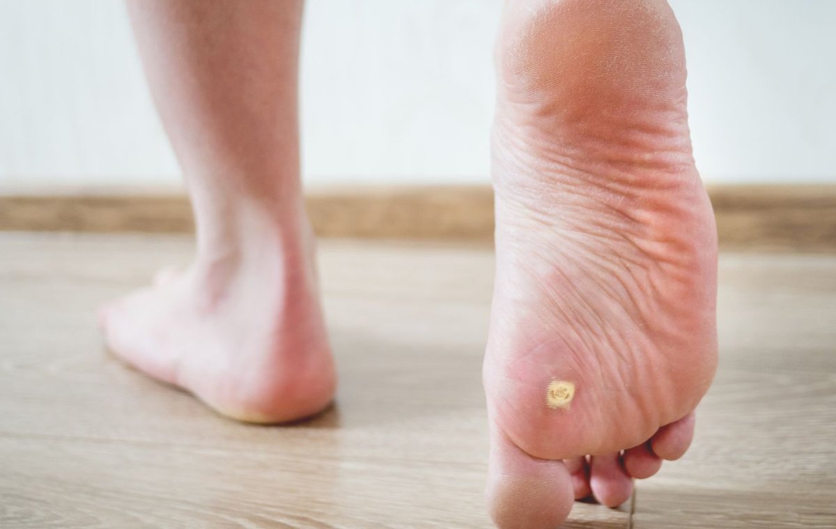 زگیل پوستی پا و زگیل های کف پا چگونه درمان می شوند؟
