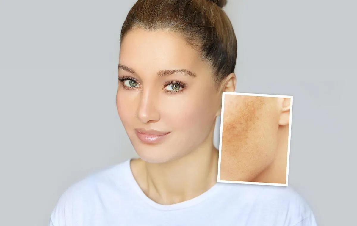 درمان قطعی لک صورت