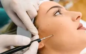 برداشتن خال صورت