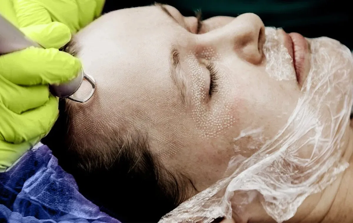 انواع لیزر برای زیبایی پوست