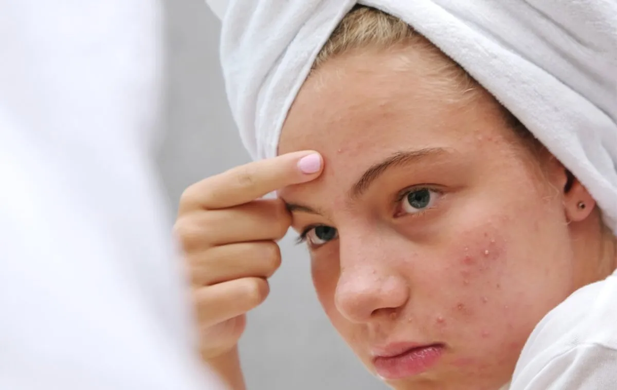 آشنایی با انواع علت جوش پیشانی