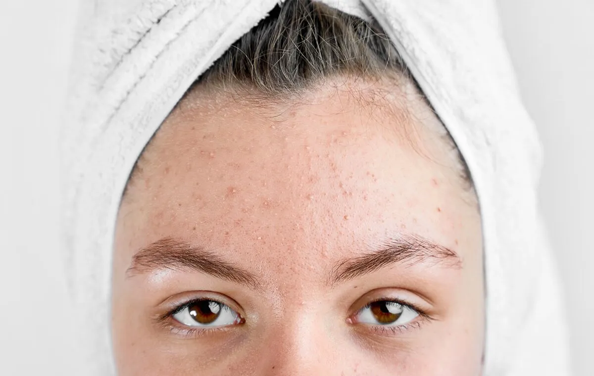 علت ایجاد جوش پیشانی چیست؟