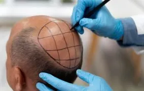 پروتز مو چیست و چه کاربردی دارد؟