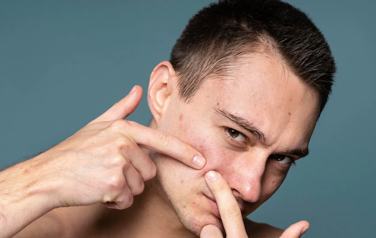 چگونه از بروز جوش پیشانی پیشگیری کنیم؟