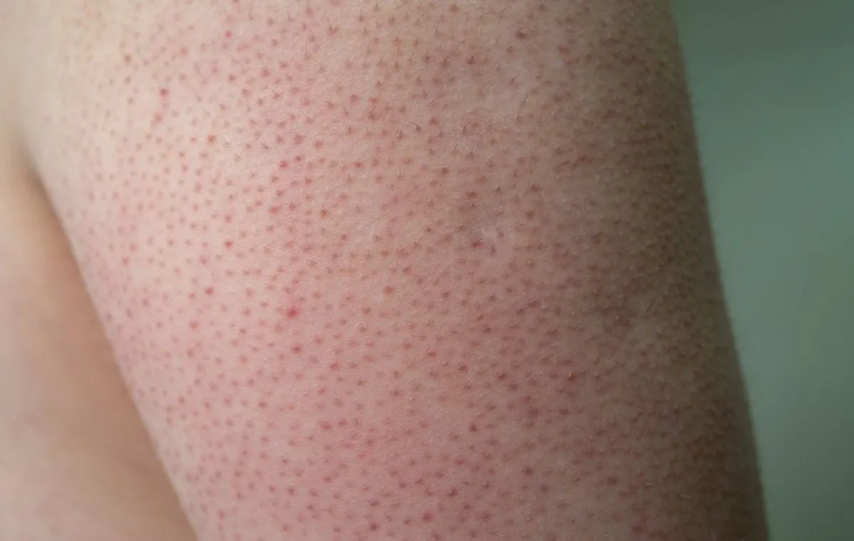 پوست مرغی یا کراتوز پیلاریس روی بازو