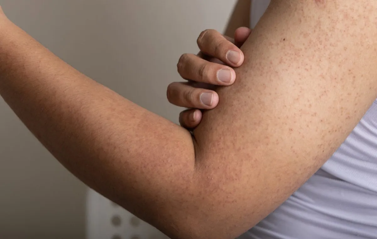 برآمدگیهای کراتوز پیلاریس روی بازو