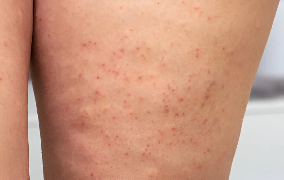 پوست مرغی شدن ران