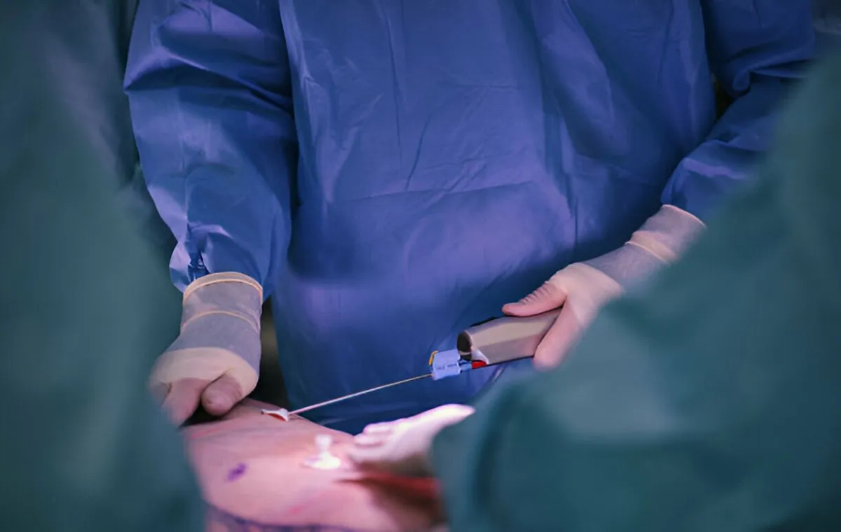 یک جراح در حال جراحی لیپوساکشن