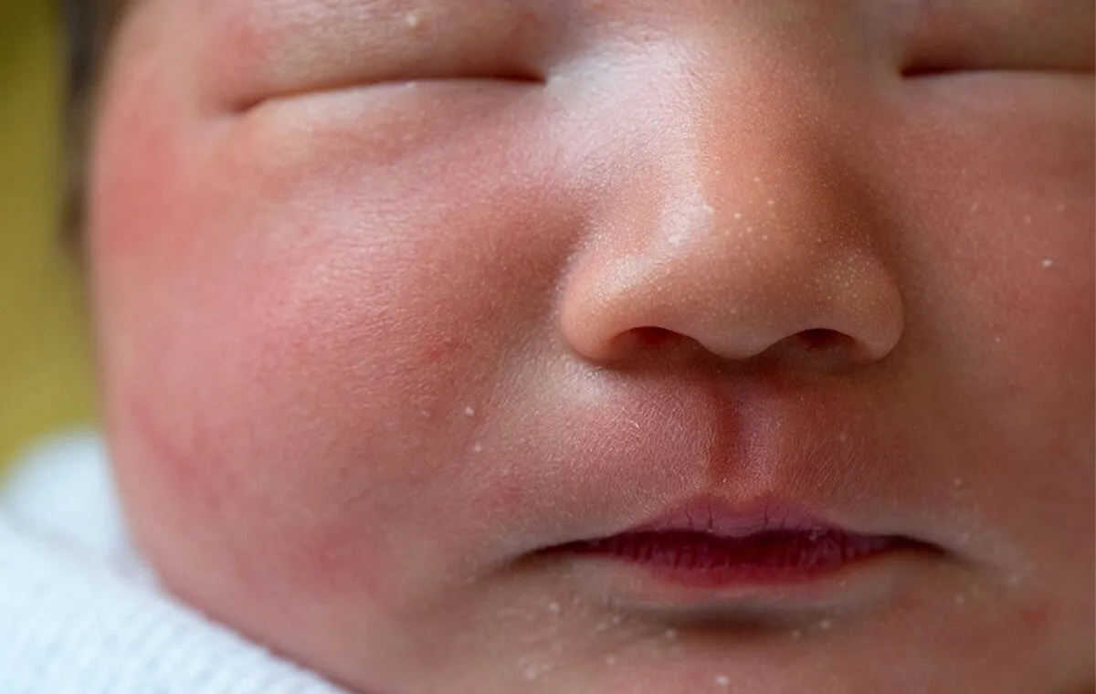 علت میلیای چشمی چیست؟