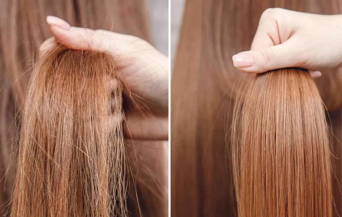 رفع وز مو با اوزون تراپی