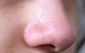 فلامنت چربی روی پوست نشانه‌ی چیست؟