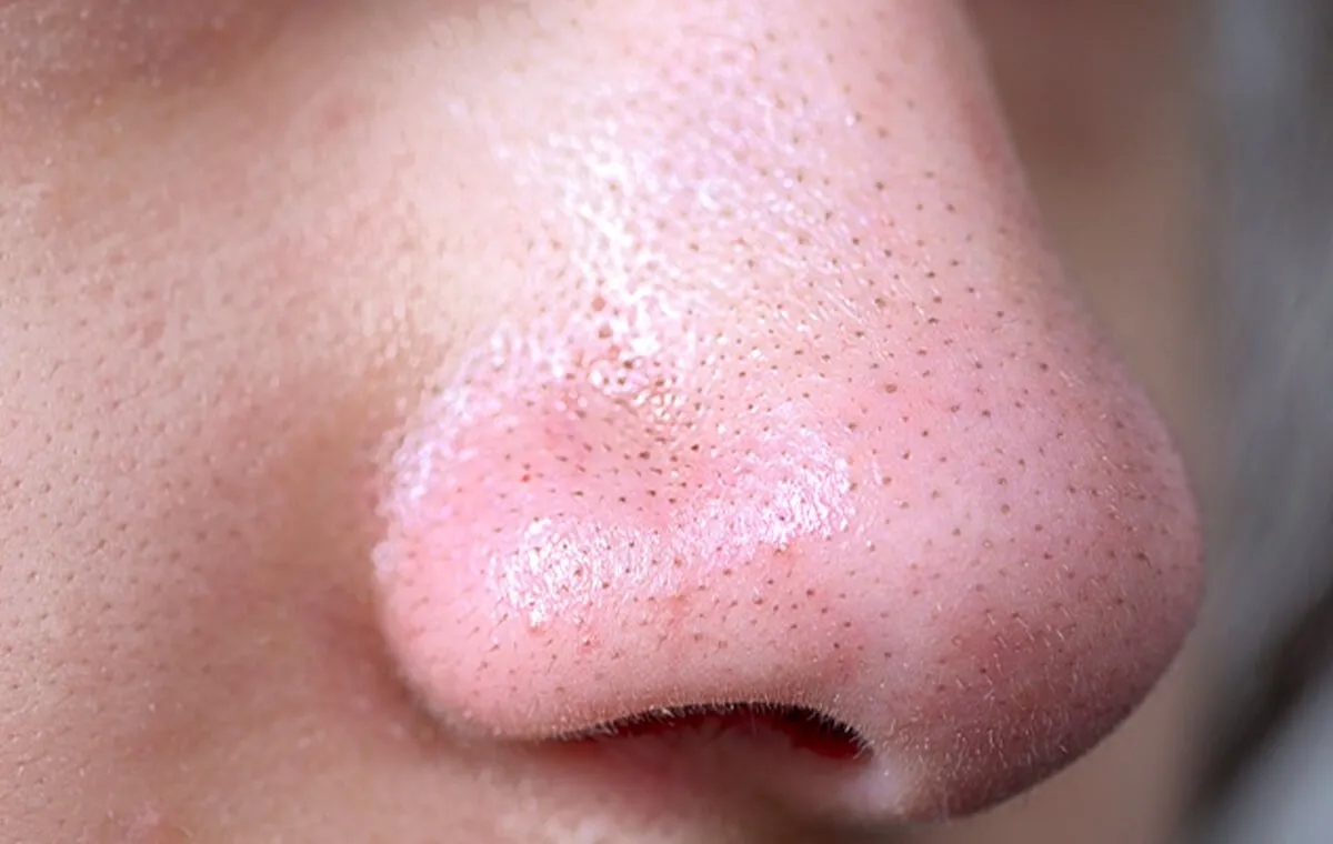 فلامنت چربی روی پوست نشانه‌ی چیست؟