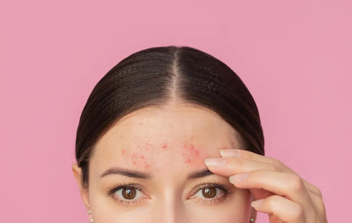 انواع جوش پیشانی و صورت