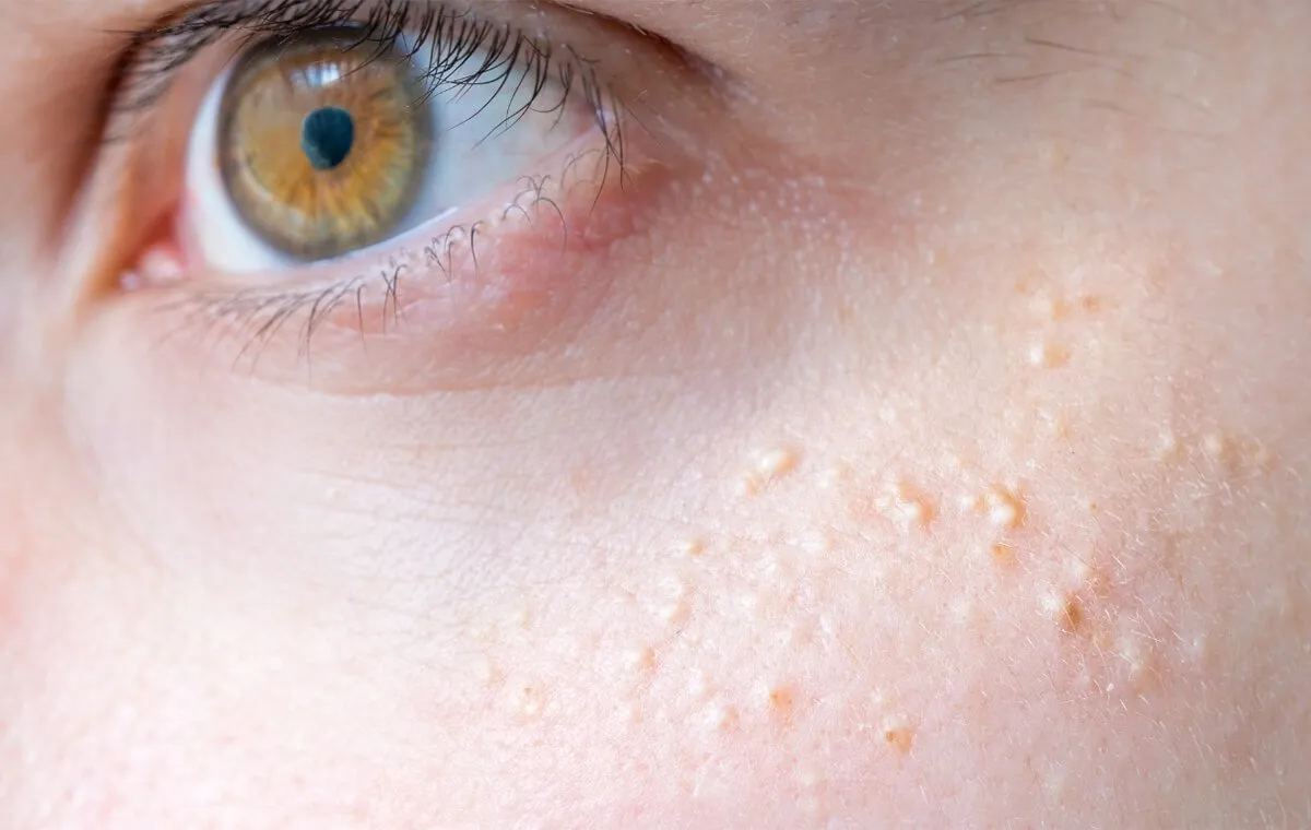 میلیای زیر چشم و صورت چیست؟