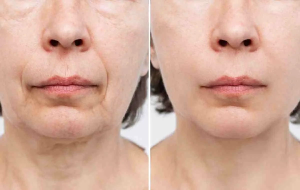 نتیجه‌ی لیفت صورت 