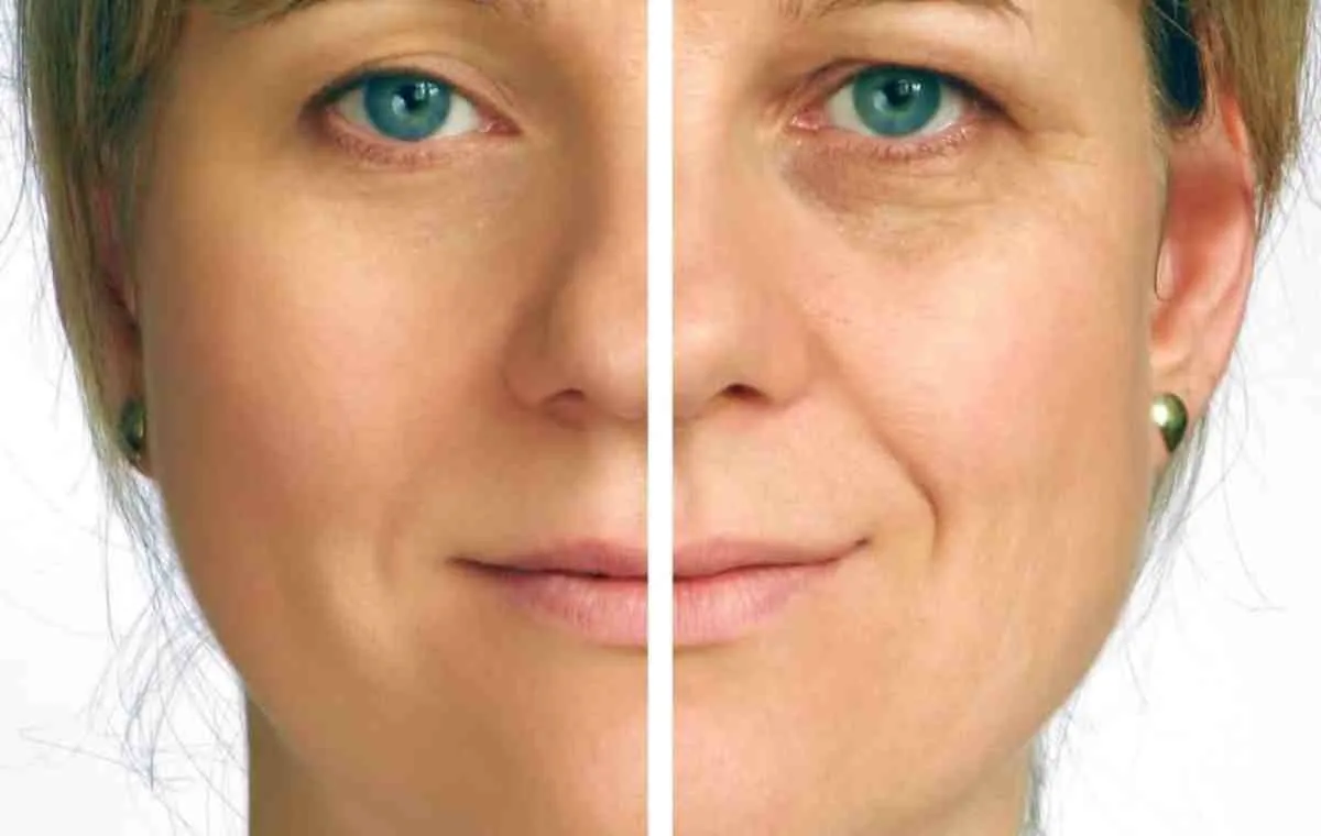 تاثیر لیفت صورت بر صورت یک زن میانسال