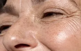 الاستین پوست چیست؟