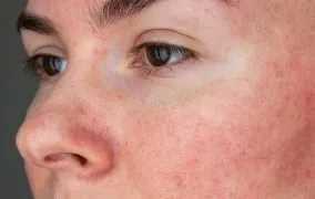 بیماری پوستی روزاسه چیست و چطور درمان می‌شود؟