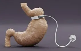 عمل حلقه معده برای لاغری