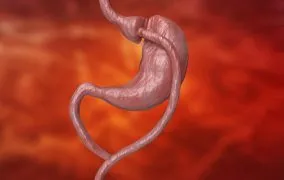 عمل بای پس معده