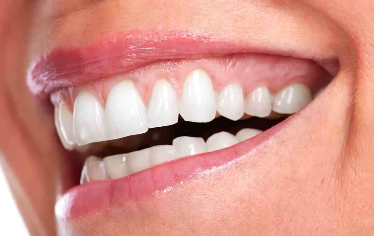 نتیجهی لیفت لثه