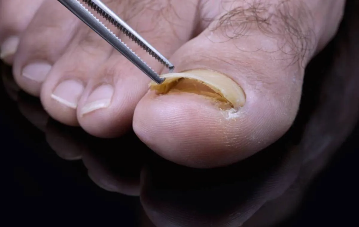 قارچ ناخن باعث برآمدن ناخن از بسترش می‌شود.