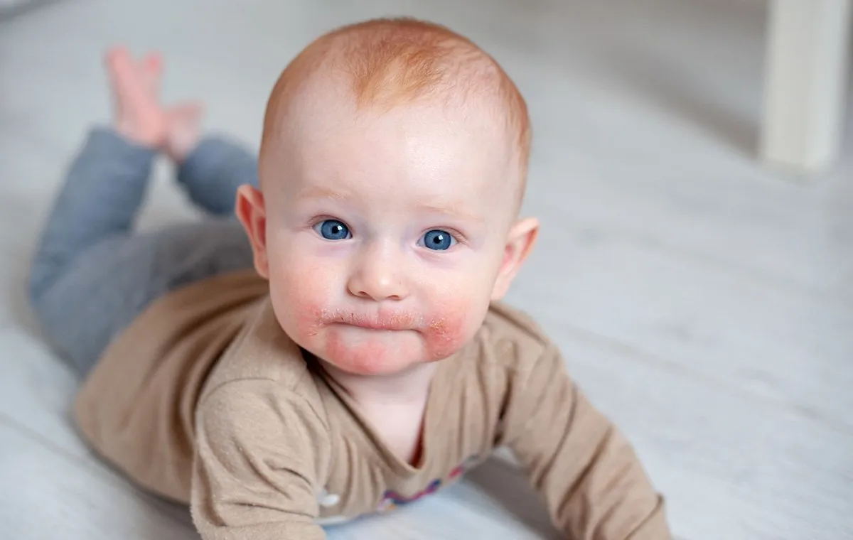 درماتیت، اگرچه ممکن است با مشکلات پوستی خفیف آغاز شود اما میتواند عوارض جدیتری را به همراه داشته باشد