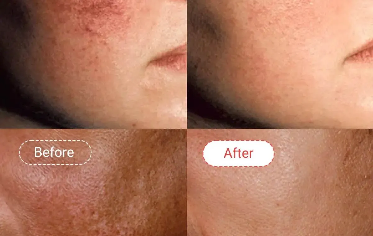 عوارض پماد آزلادرم چیست