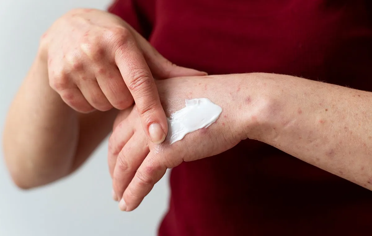 پماد کالامین برای چیست و چه کاربردی دارد؟