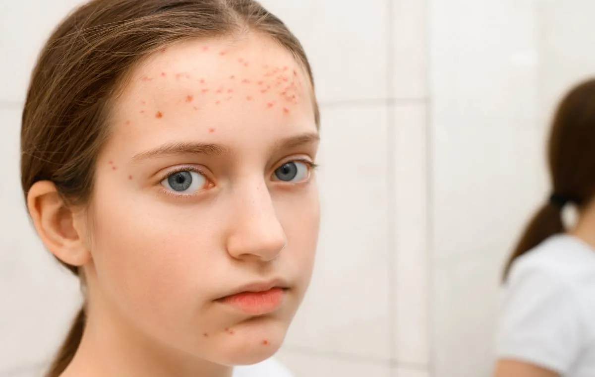 آکنه کودکان