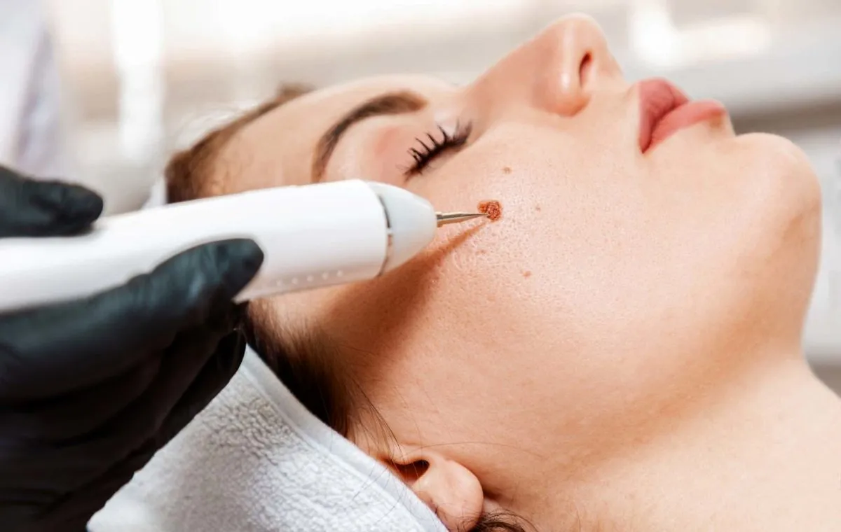 بهترین پماد بعد از برداشتن خال